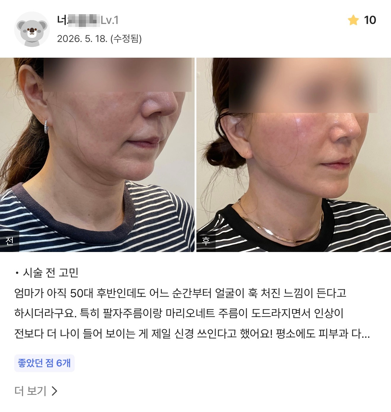 강남언니 게재 환자 후기 1