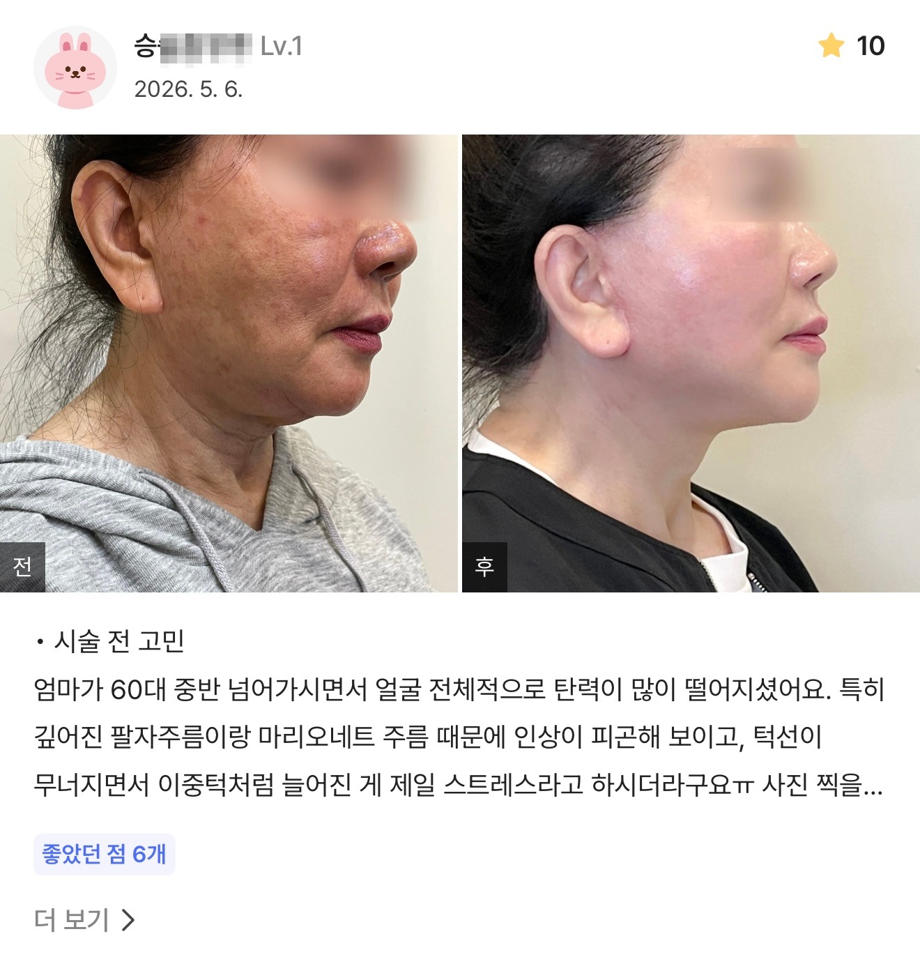 강남언니 게재 환자 후기 3