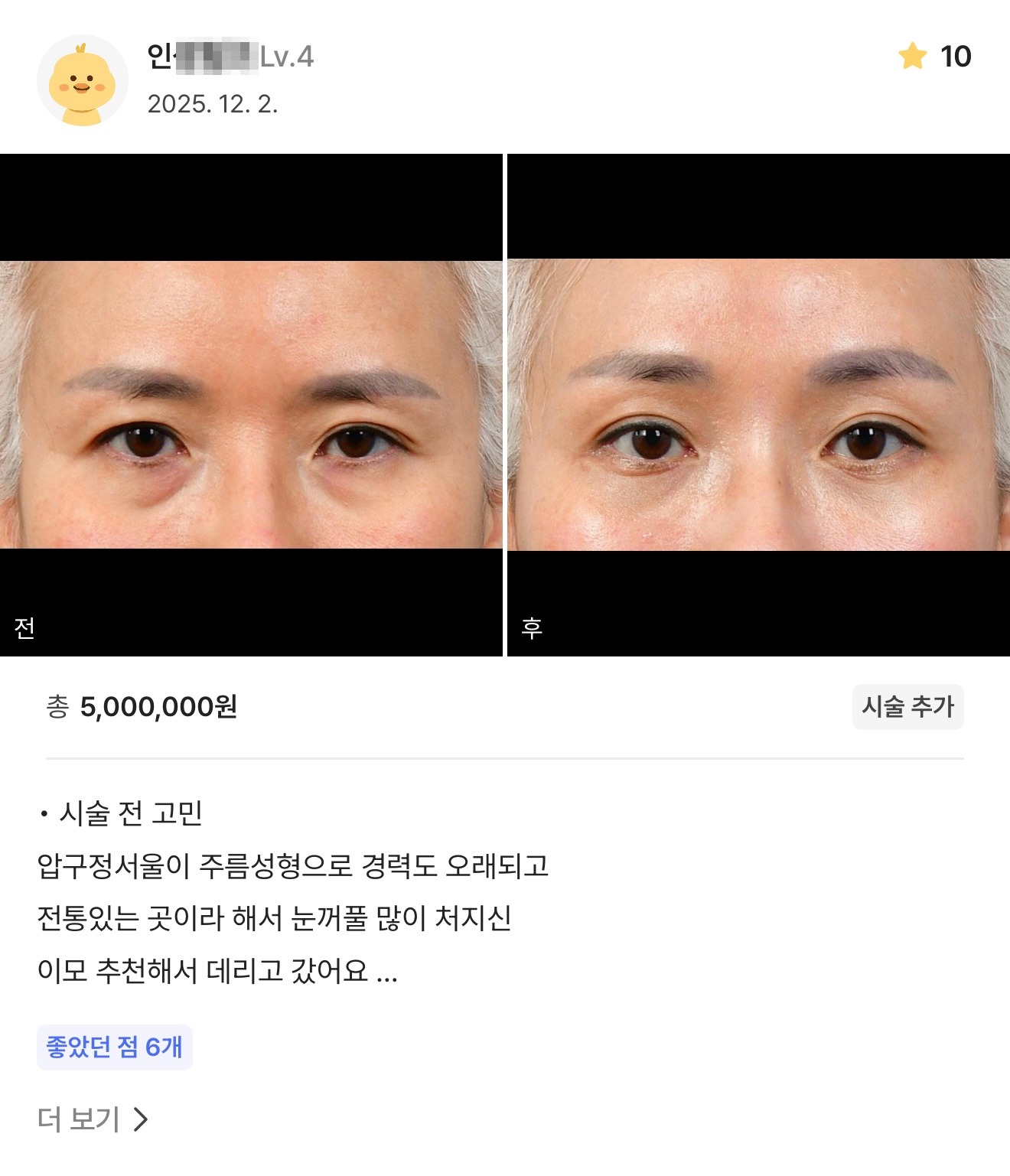 강남언니 게재 환자 후기 4