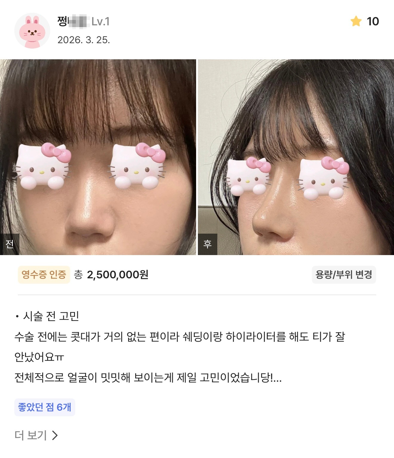 강남언니 게재 환자 후기 5