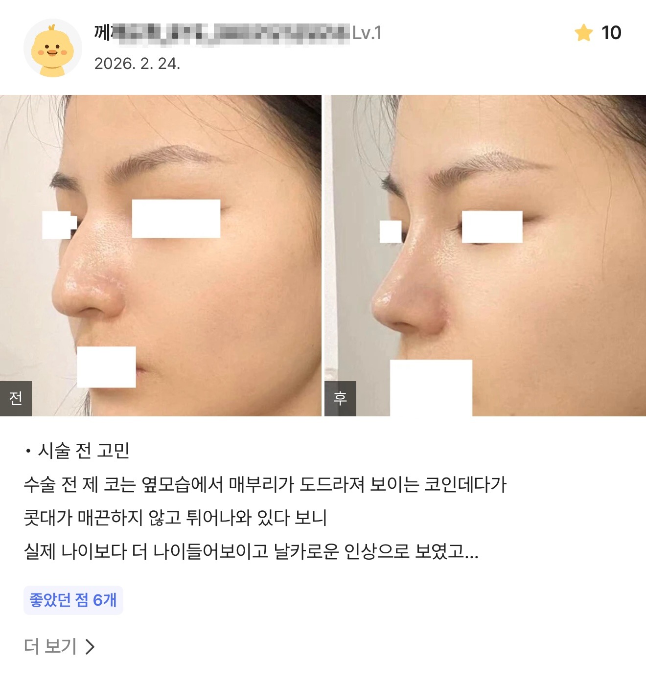 강남언니 게재 환자 후기 8