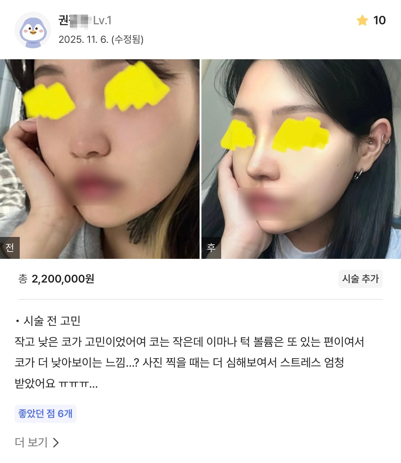 강남언니 게재 환자 후기 9