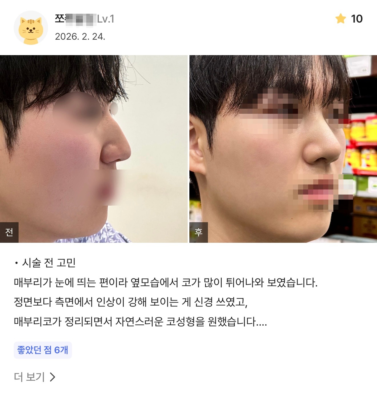 강남언니 게재 환자 후기 10